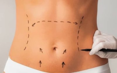 ¿Qué es una abdominoplastia?